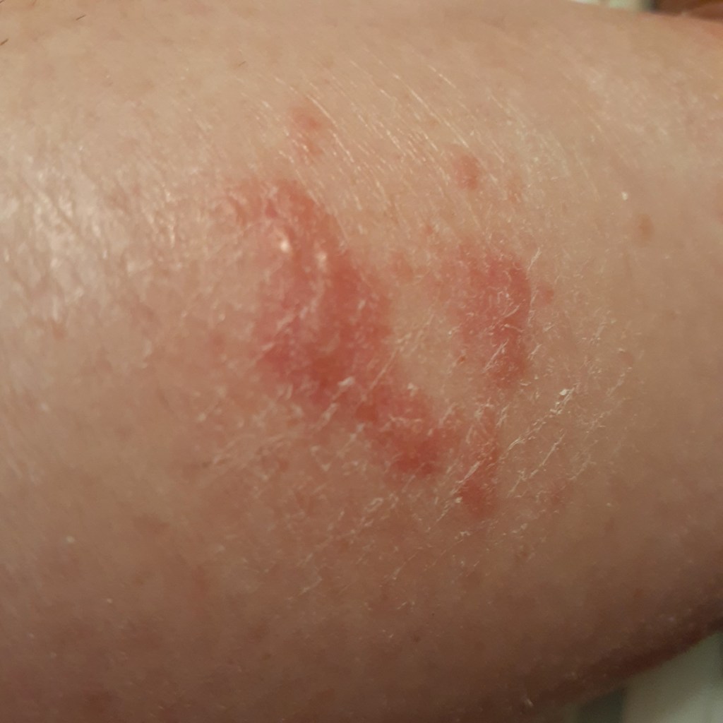 Stop the Spread Stop the&nbsp;Itch